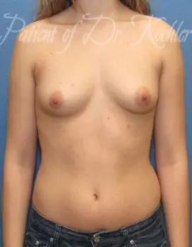 Breast Augmentation Patient Photo - Case 25 - before view-0