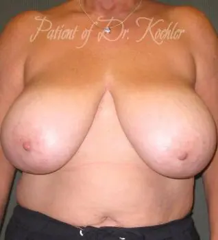 Breast Reduction - Case 68 - Before