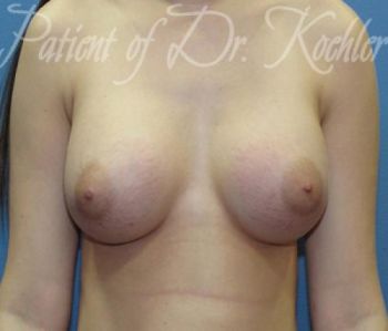 Breast Augmentation Patient Photo - Case 43 - after view-0