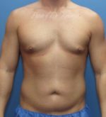 Liposuction - Case 83 - Before
