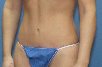 Tummy Tuck Patient Photo - Case 100 - after view-2