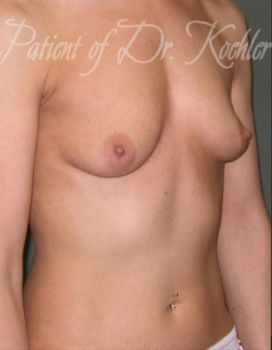 Breast Augmentation Patient Photo - Case 20 - before view-2