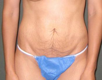 Tummy Tuck Patient Photo - Case 95 - before view-0