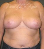 Breast Reduction - Case 68 - After