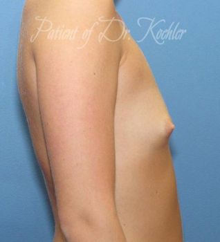 Breast Augmentation Patient Photo - Case 52 - before view-1