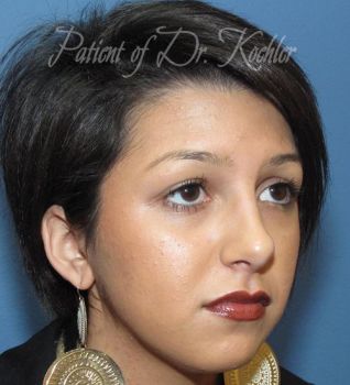 Rhinoplasty Patient Photo - Case 89 - after view-2