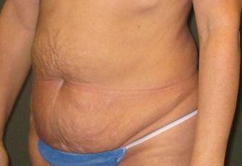 Tummy Tuck Patient Photo - Case 93 - before view-2