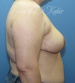 Breast Reduction Patient Photo - Case 66 - after view-1
