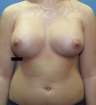 Breast Augmentation Patient Photo - Case 49 - after view-0