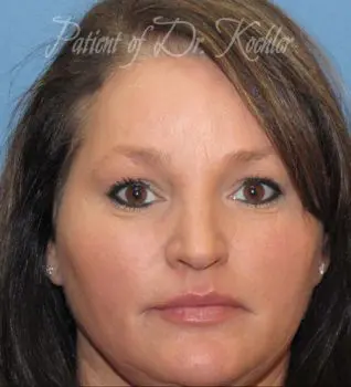 Brow Lift Patient Photo - Case 71 - after view