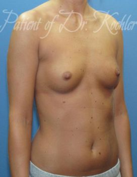Breast Augmentation Patient Photo - Case 42 - before view-2