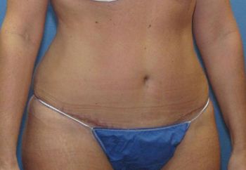 Tummy Tuck Patient Photo - Case 97 - after view-2