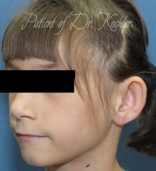 Ear Surgery Patient Photo - Case 75 - before view-2