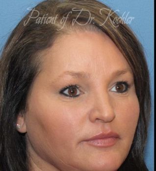 Brow Lift Patient Photo - Case 71 - after view-2