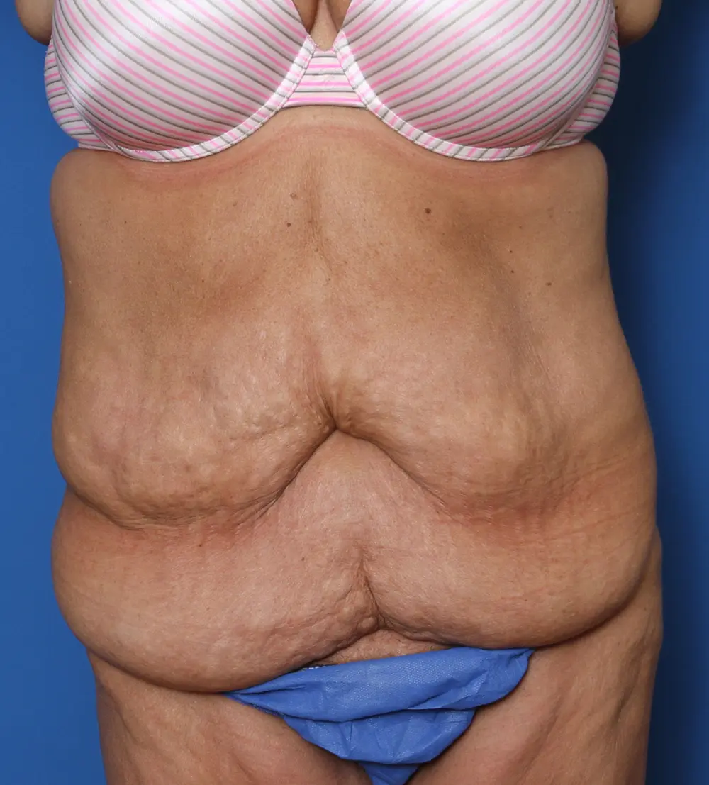 Belt Lipectomy Patient Photo - Case 144 - before view-
