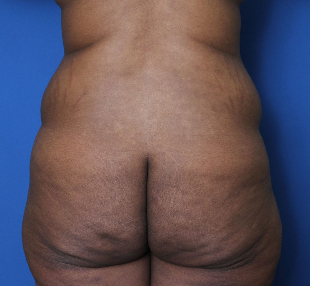 Liposuction Patient Photo - Case 159 - before view-0