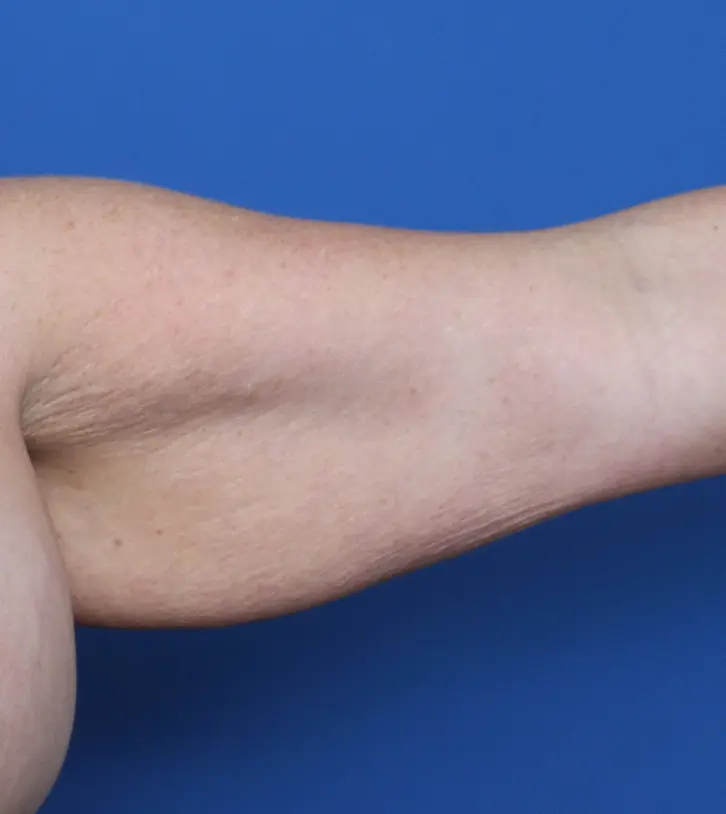 Arm Lift - Case 154 - Before