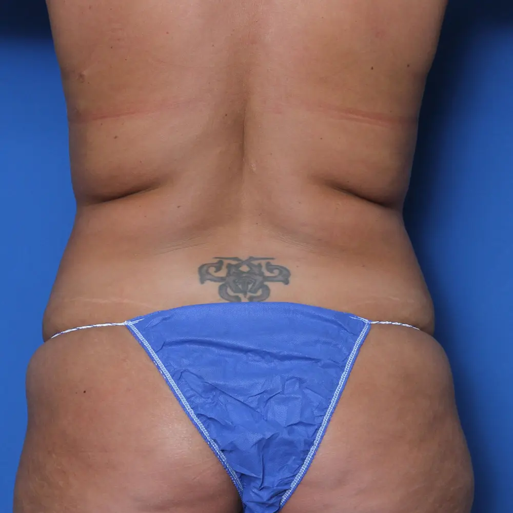 Liposuction Patient Photo - Case 155 - before view-0