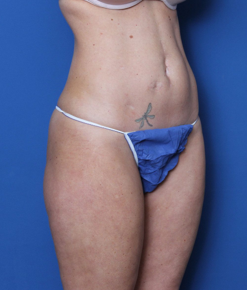 Liposuction Patient Photo - Case 156 - before view-1