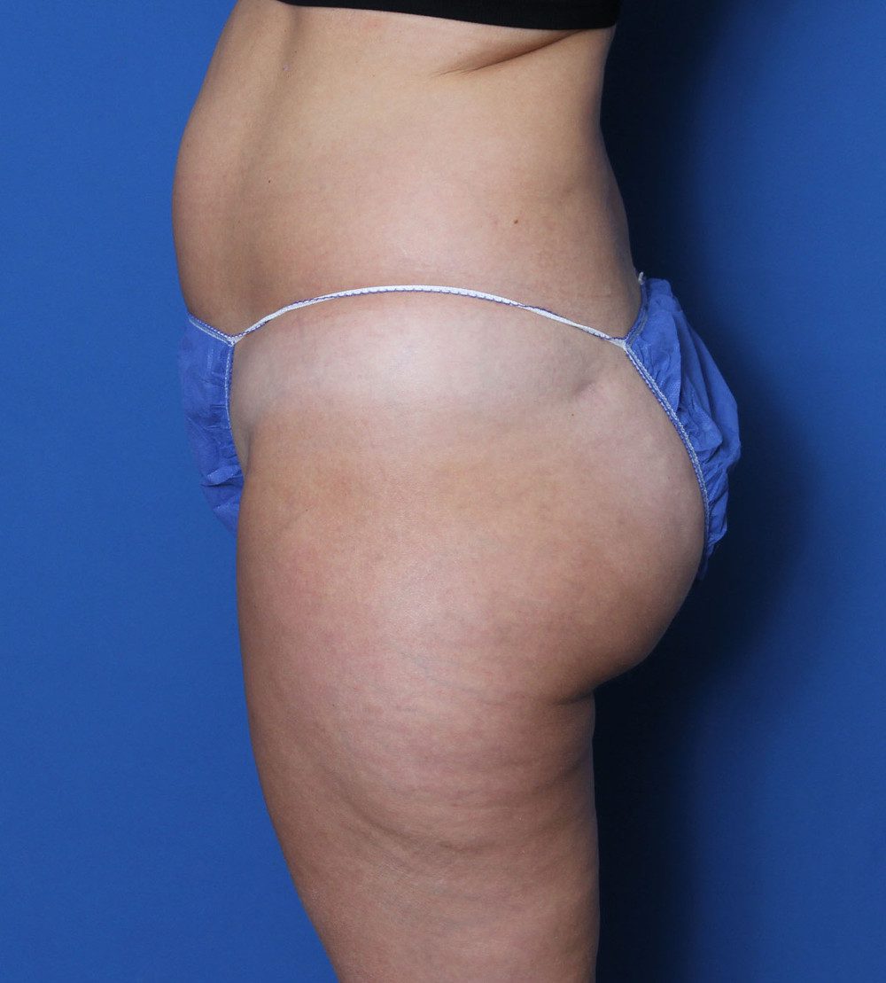 Liposuction Patient Photo - Case 157 - before view-1