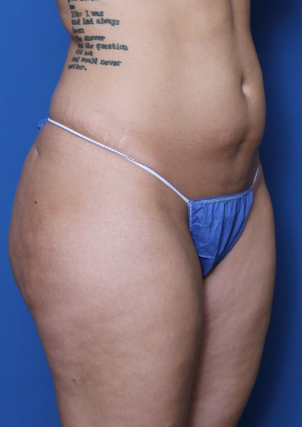 Liposuction Patient Photo - Case 158 - before view-1