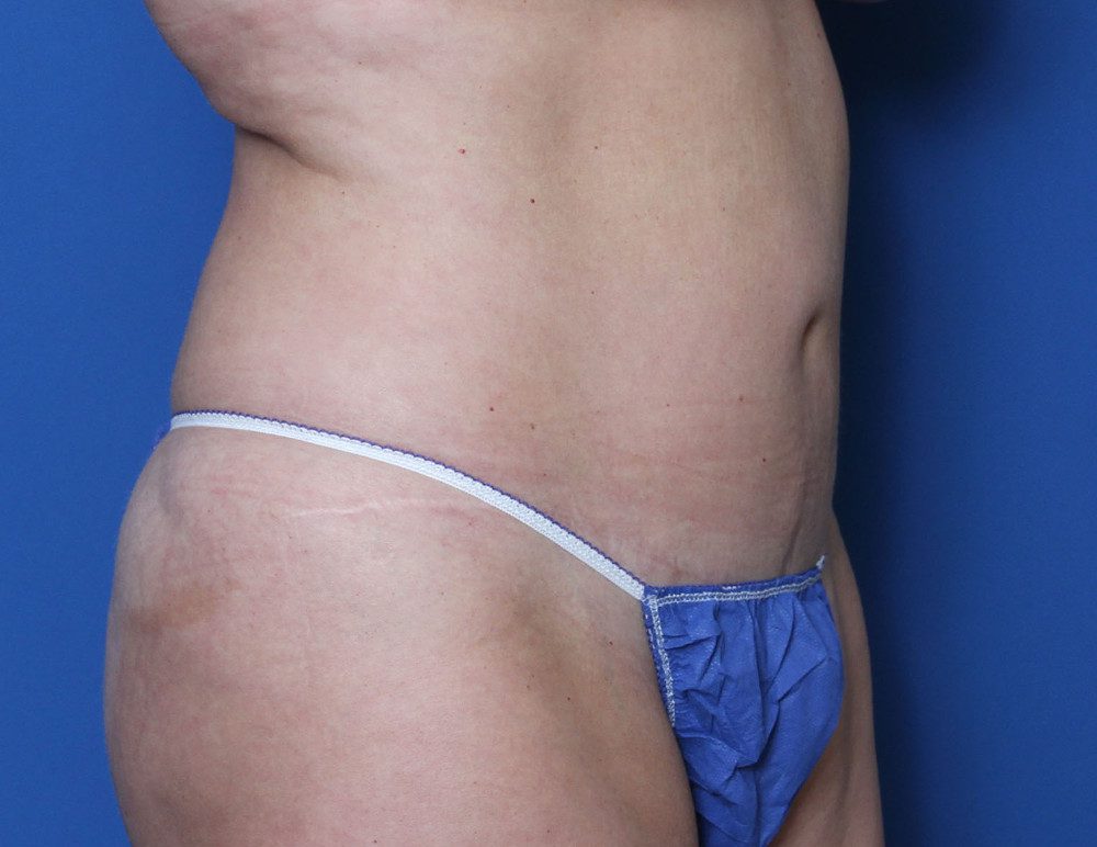 Liposuction Patient Photo - Case 160 - before view-1