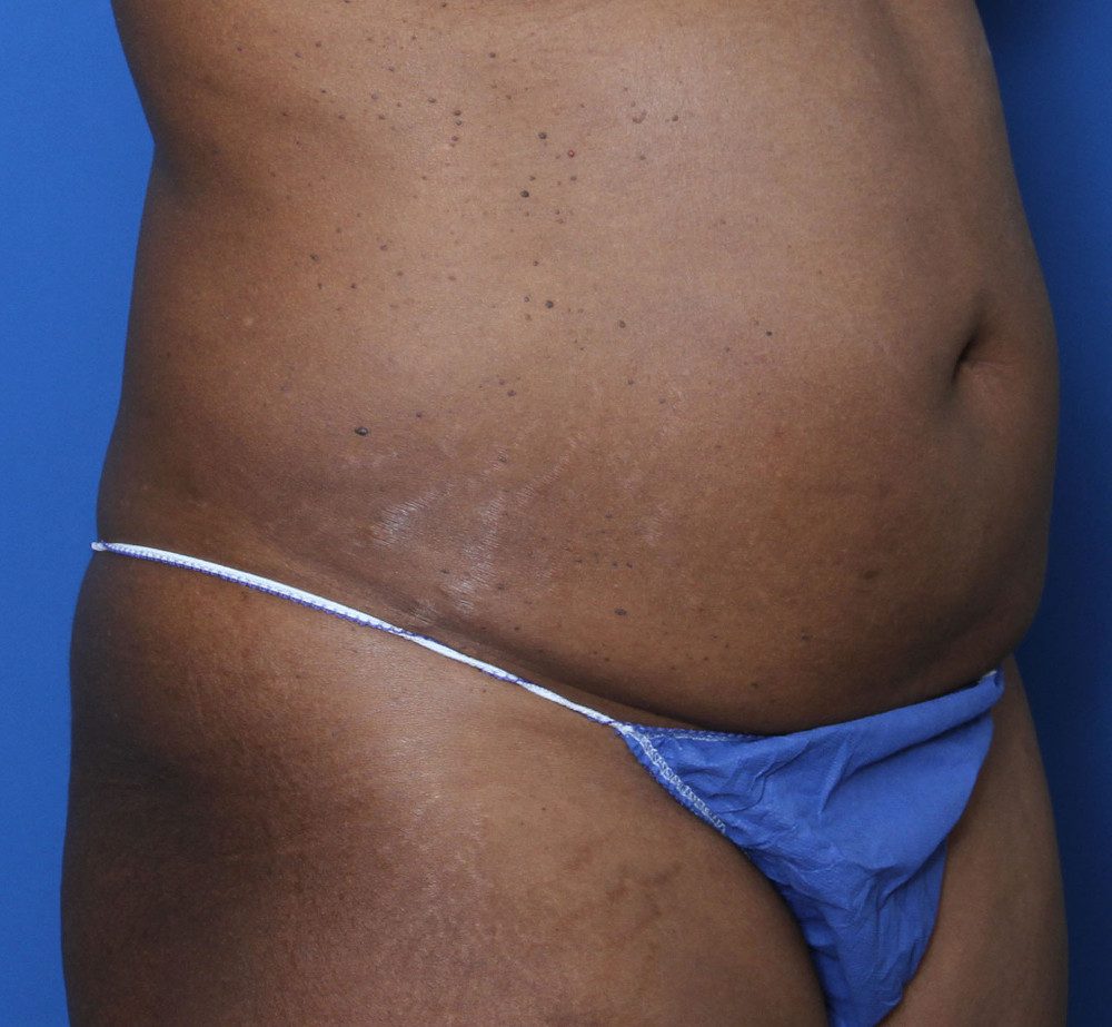 Tummy Tuck Patient Photo - Case 134 - before view-1