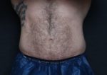 CoolSculpting - Case 162 - Before