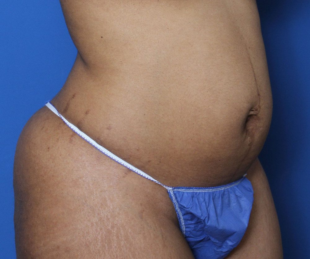 Tummy Tuck Patient Photo - Case 135 - before view-1
