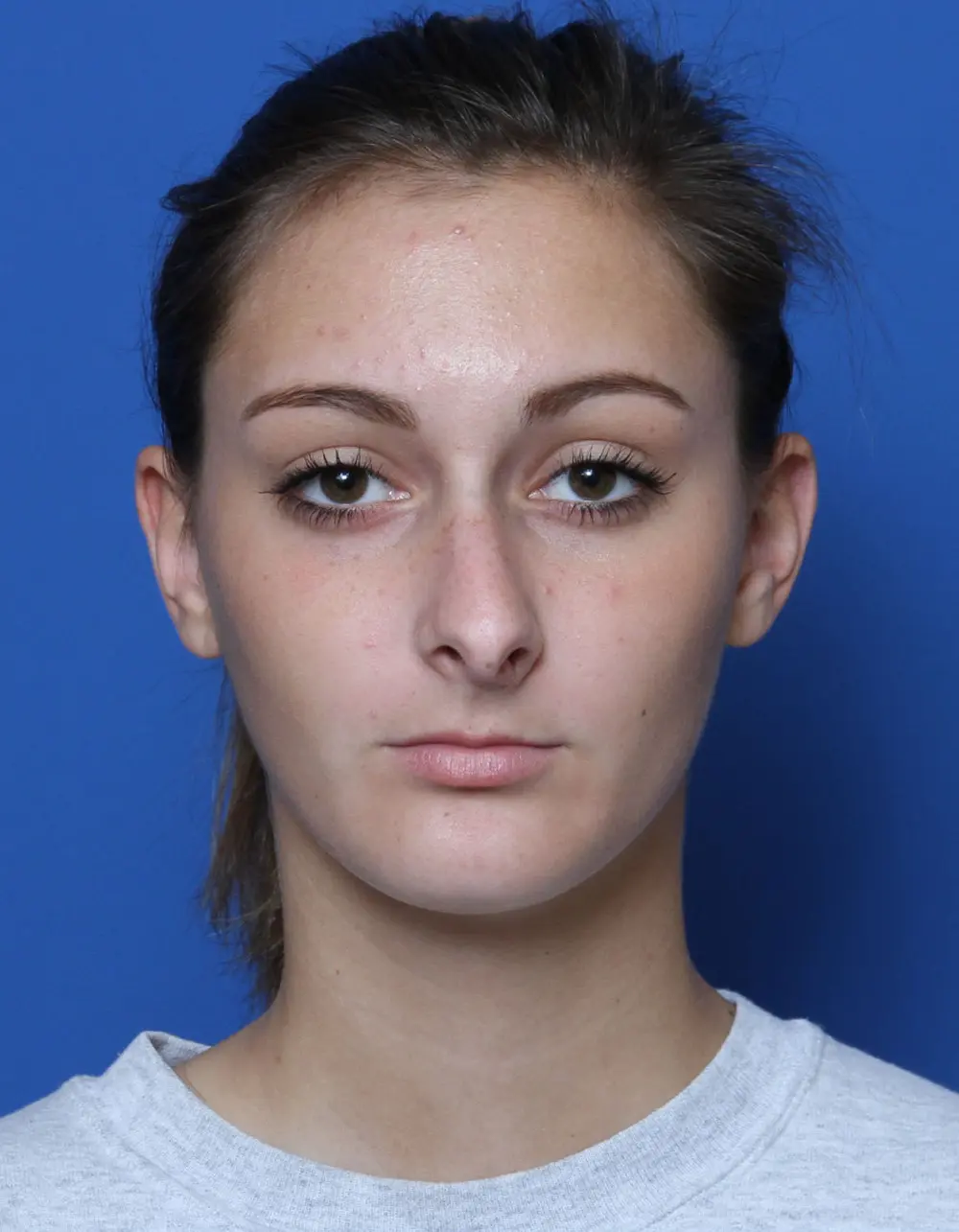 Rhinoplasty Patient Photo - Case 172 - before view-