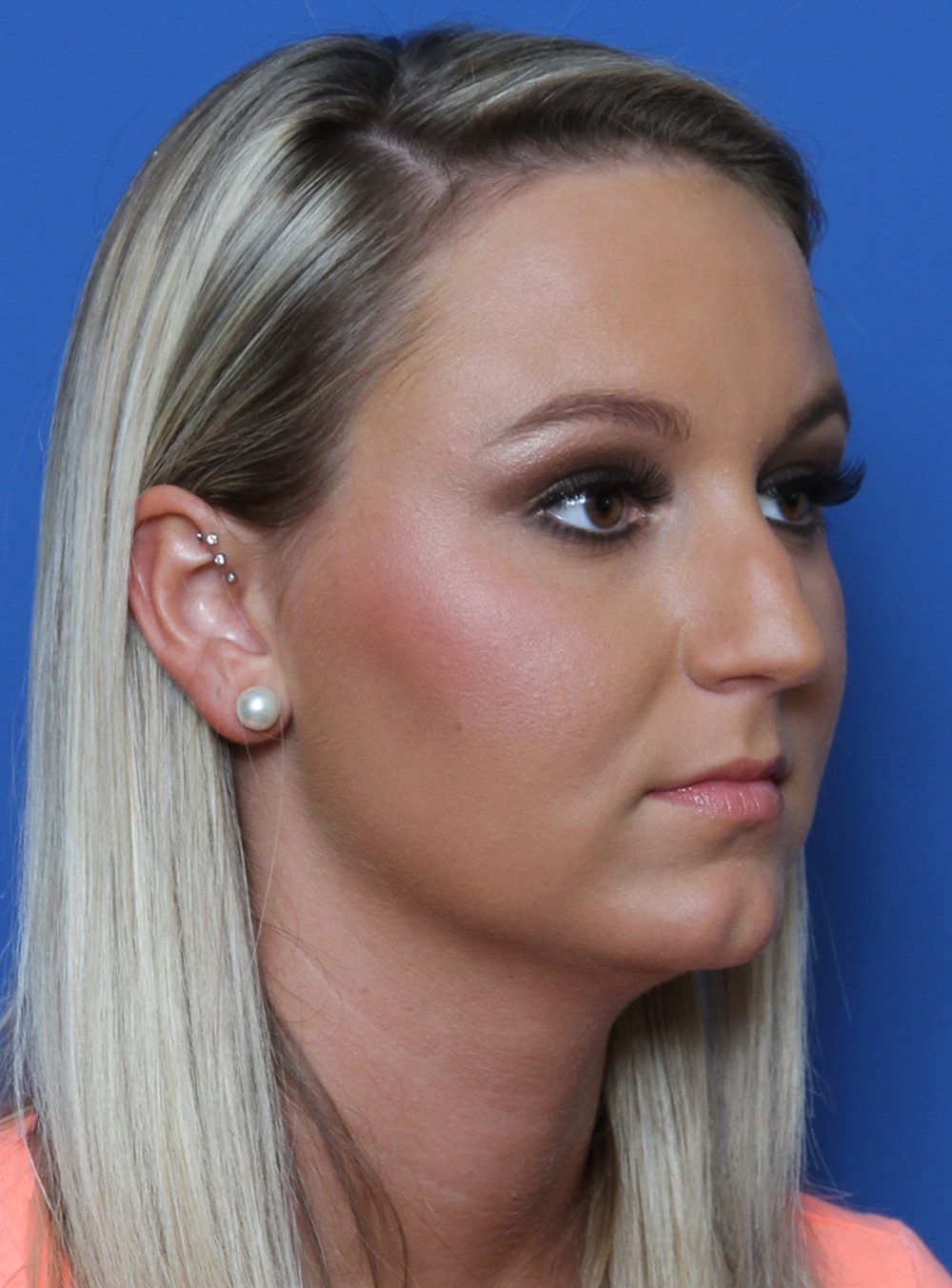Rhinoplasty Patient Photo - Case 175 - before view-1