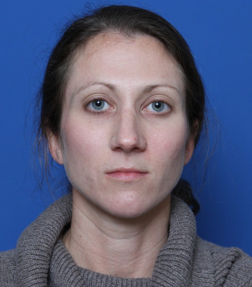 Rhinoplasty Patient Photo - Case 176 - before view-0