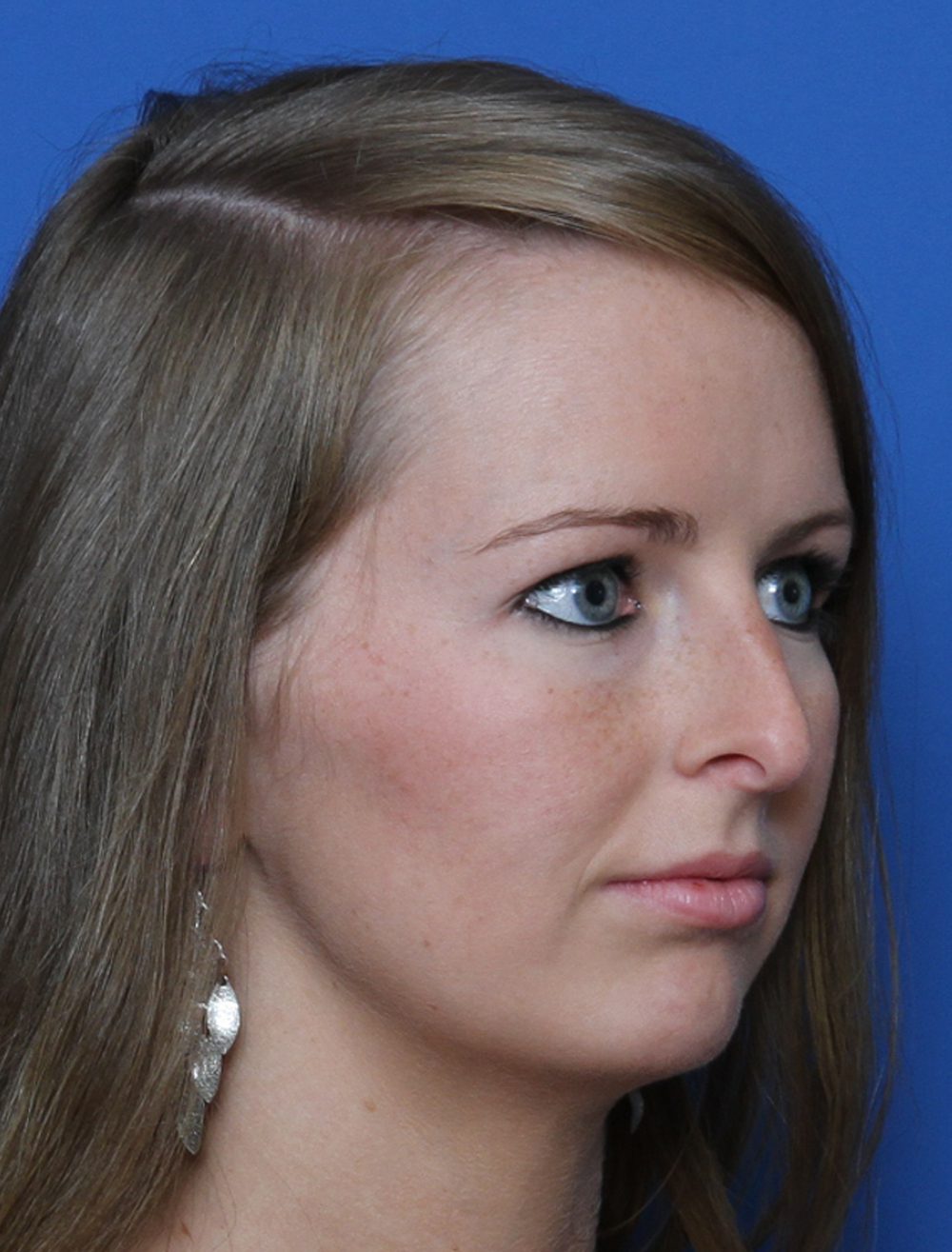Rhinoplasty Patient Photo - Case 177 - before view-1