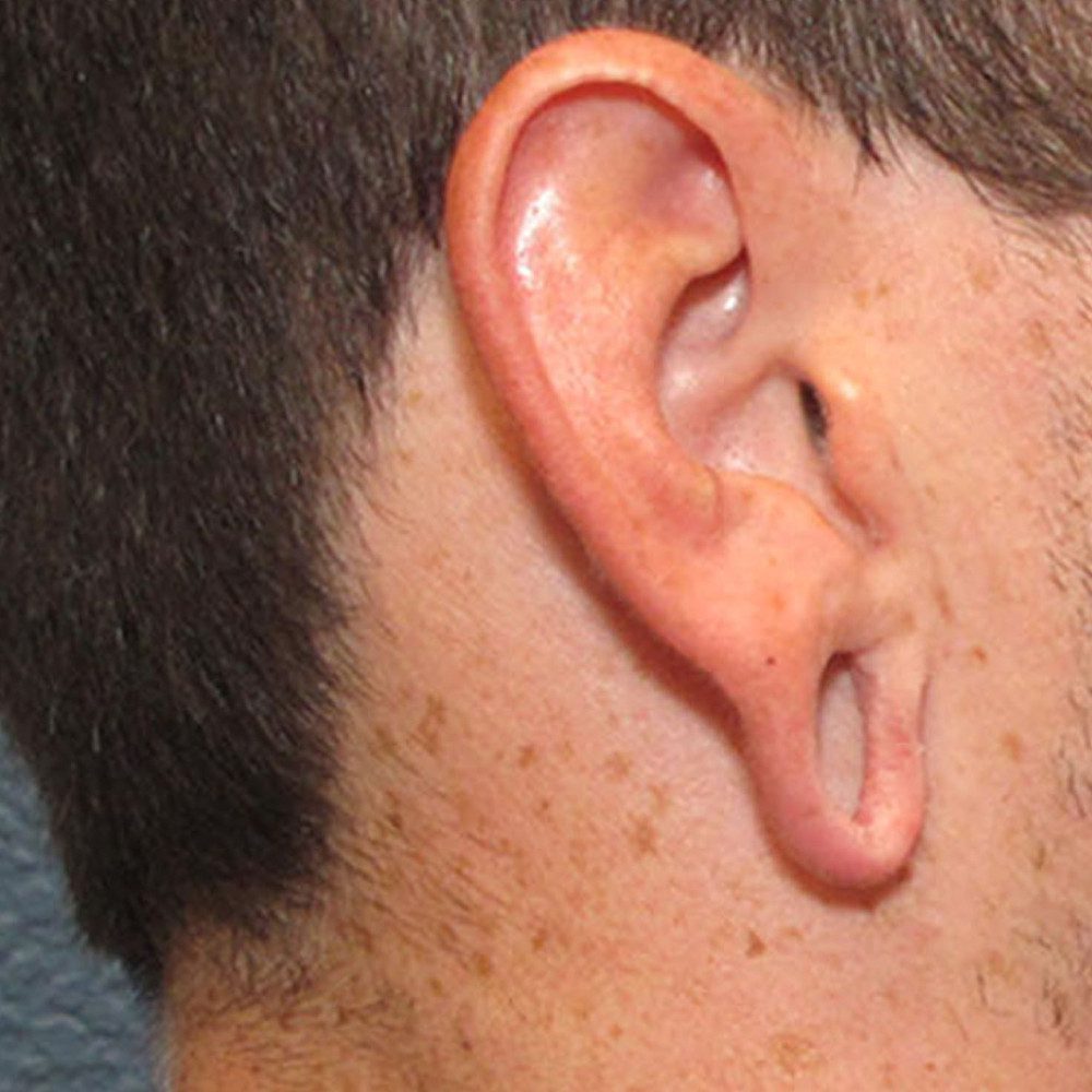 Ear Surgery Patient Photo - Case 178 - before view-