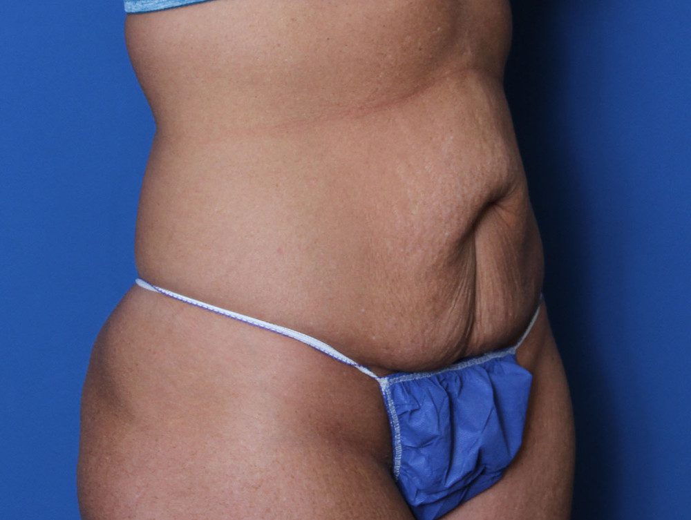 Tummy Tuck Patient Photo - Case 137 - before view-1