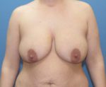 Breast Lift - Case 198 - Before