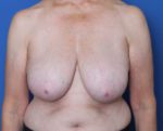 Breast Lift - Case 199 - Before