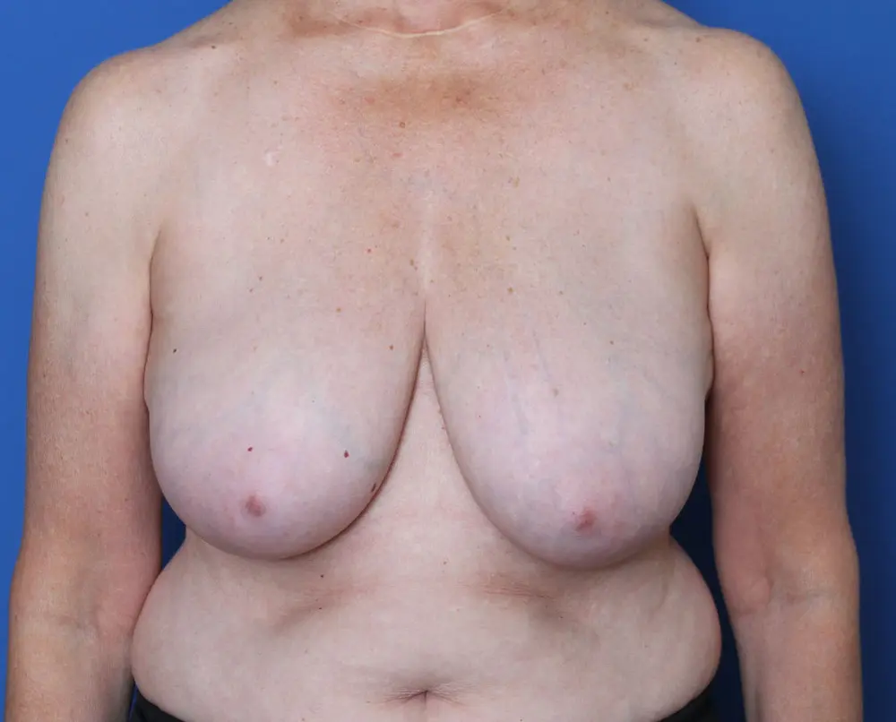 Breast Lift Patient Photo - Case 199 - before view-0