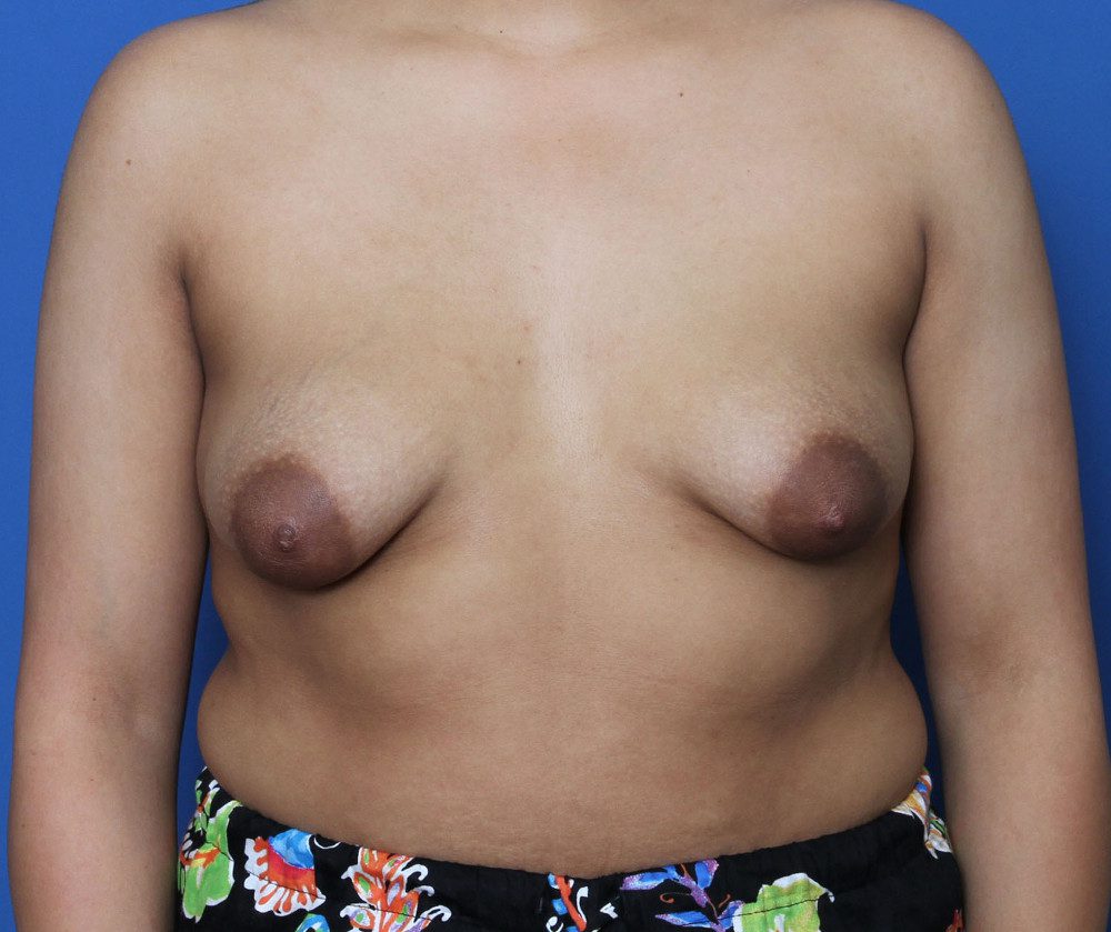 Breast Lift Patient Photo - Case 200 - before view-