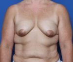 Breast Lift - Case 202 - Before