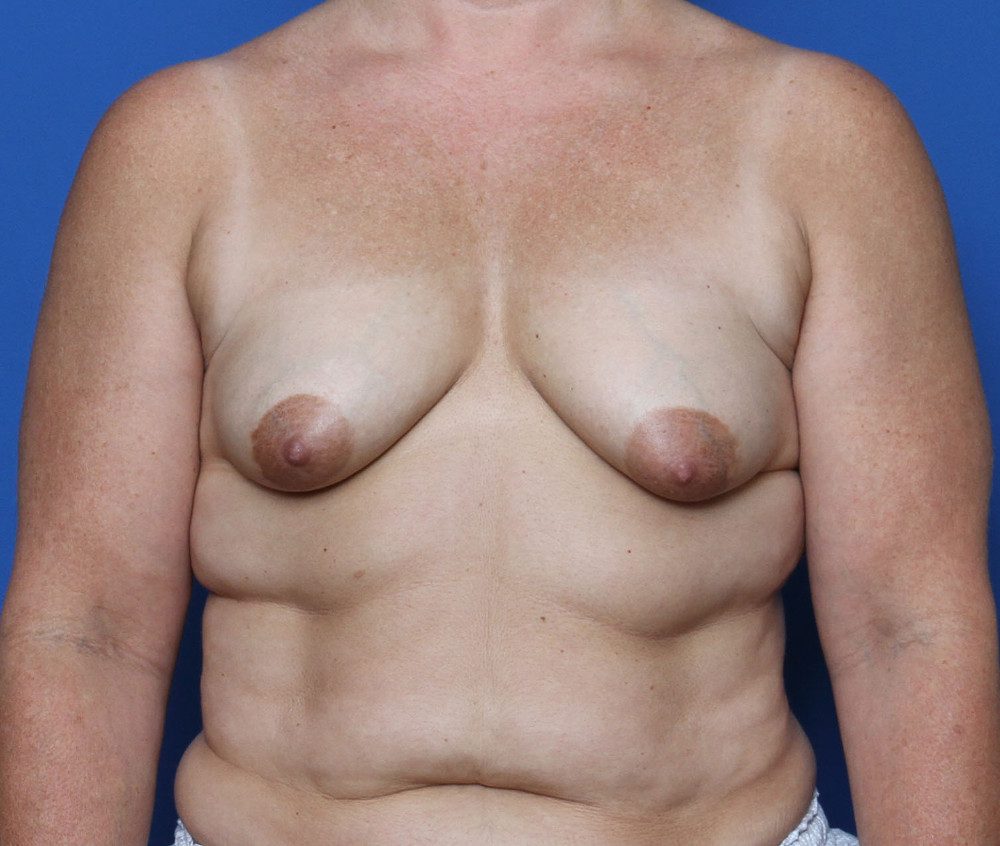 Breast Lift Patient Photo - Case 202 - before view-0