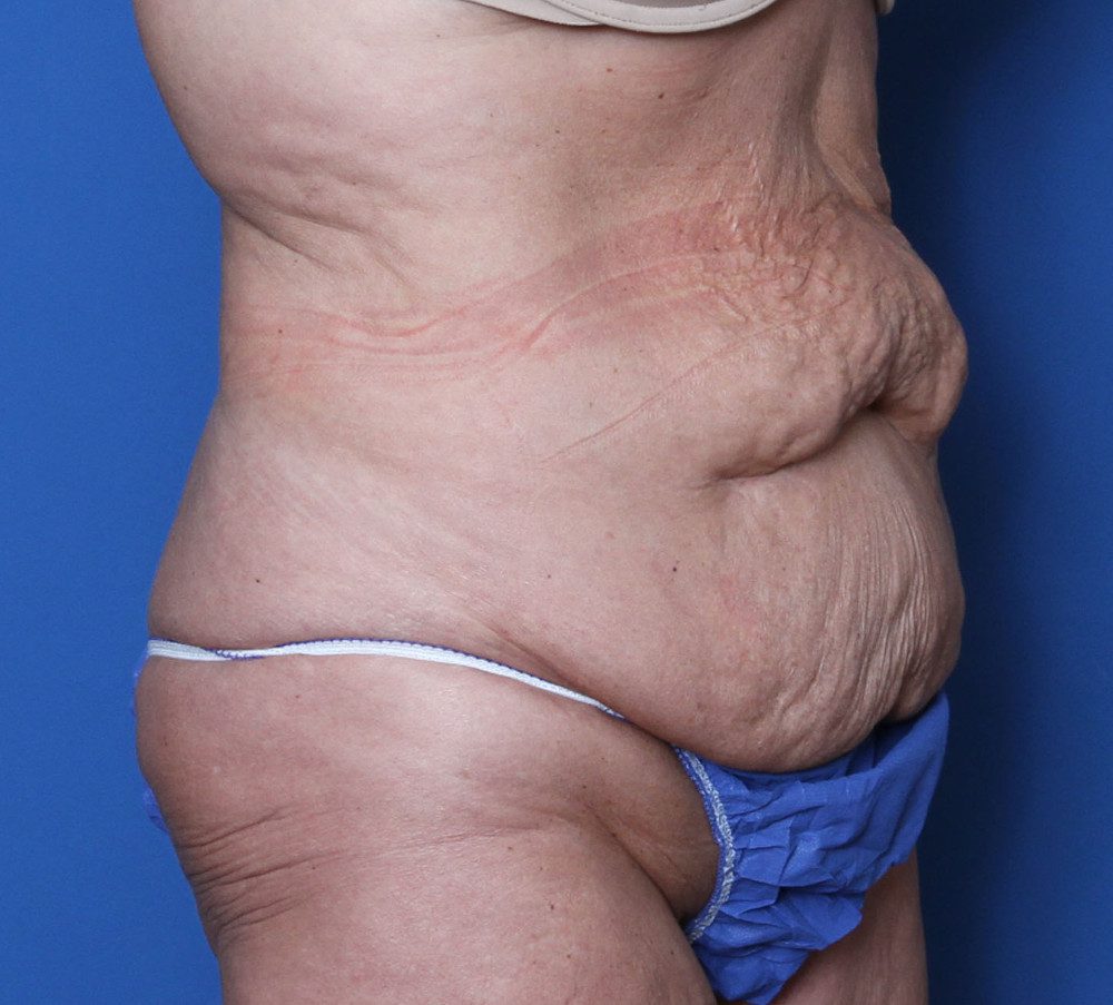 Belt Lipectomy Patient Photo - Case 139 - before view-1