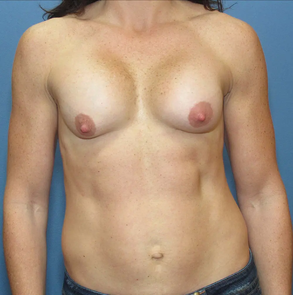 Breast Revision - Case 212 - Before
