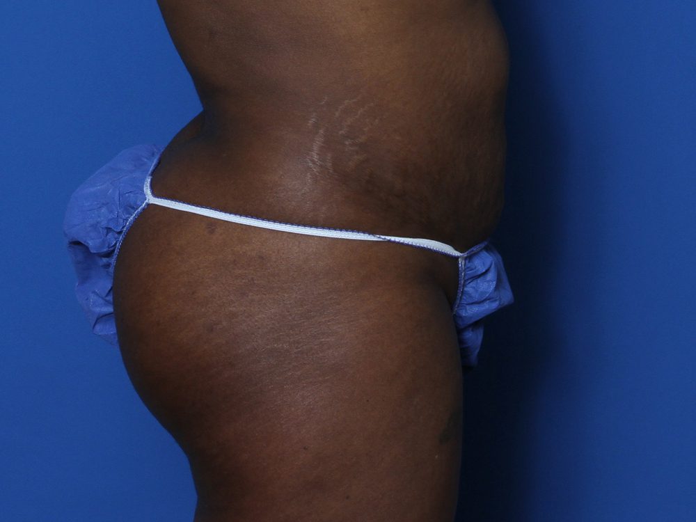 Tummy Tuck Patient Photo - Case 131 - before view-1