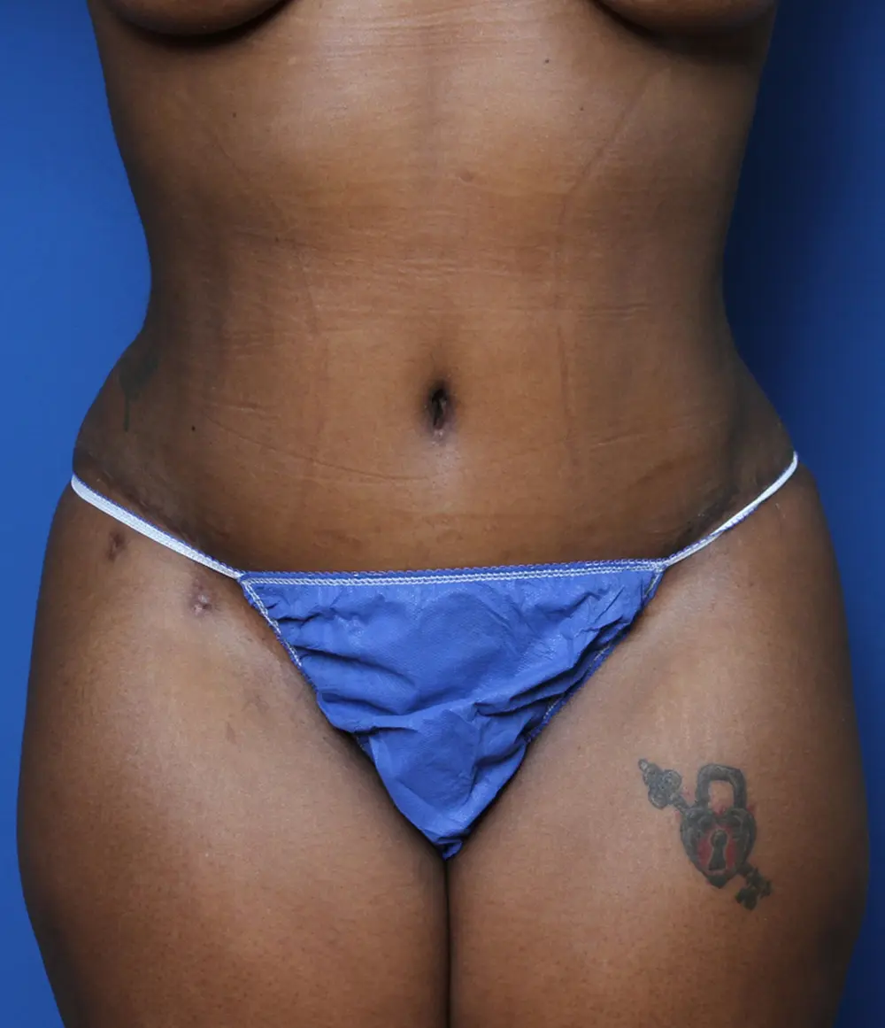 Tummy Tuck Patient Photo - Case 132 - after view