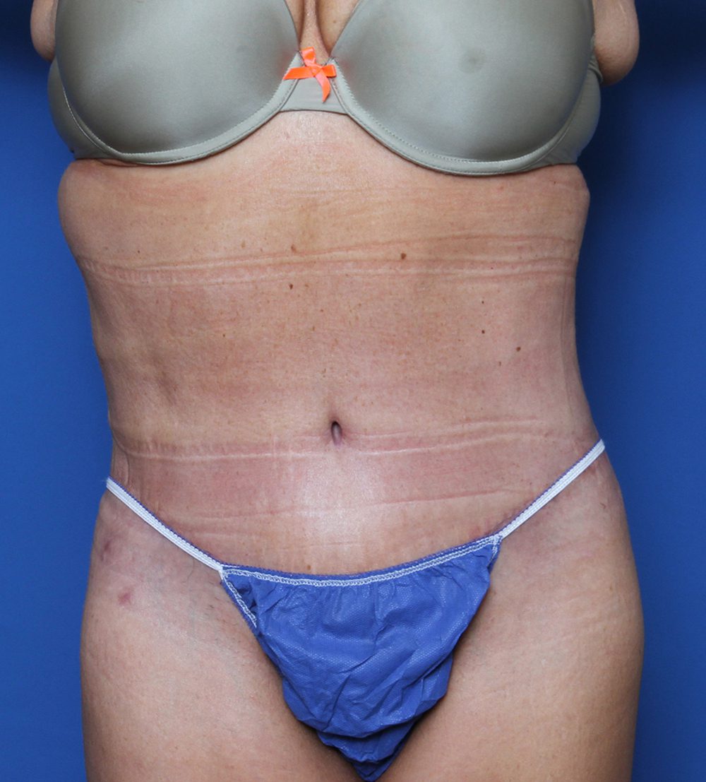 Belt Lipectomy Patient Photo - Case 144 - after view-0