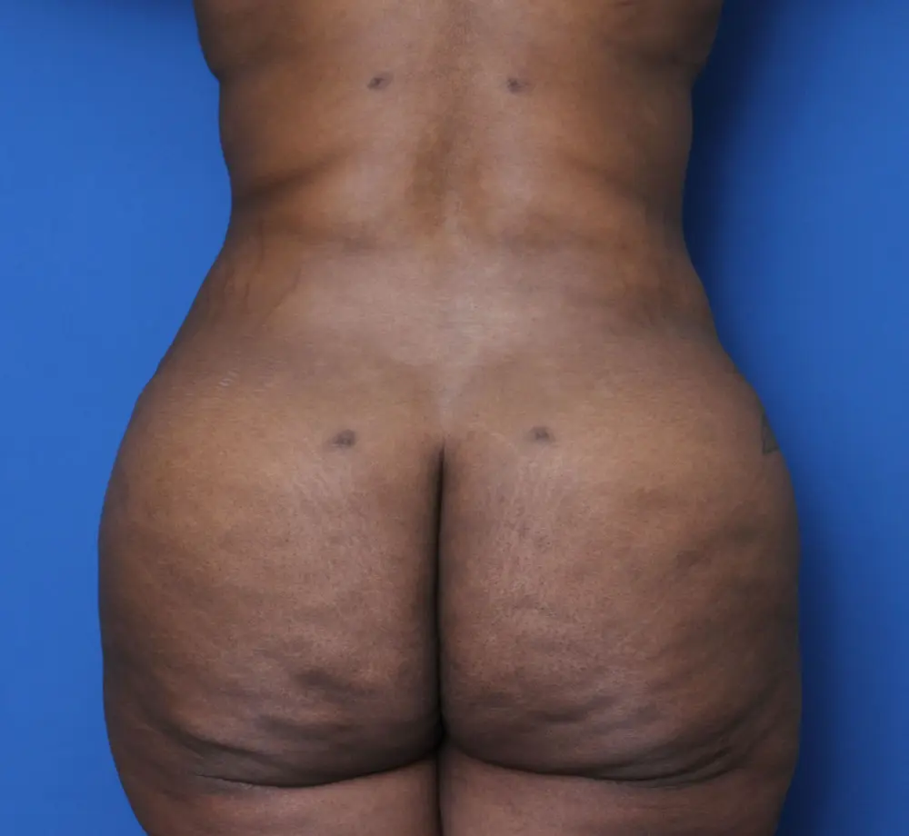 Liposuction Patient Photo - Case 159 - after view