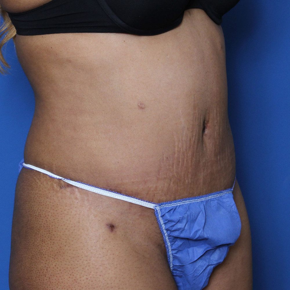 Tummy Tuck Patient Photo - Case 133 - after view-1