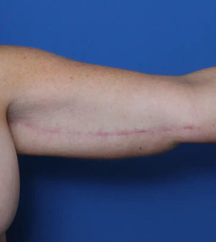 Arm Lift - Case 154 - After