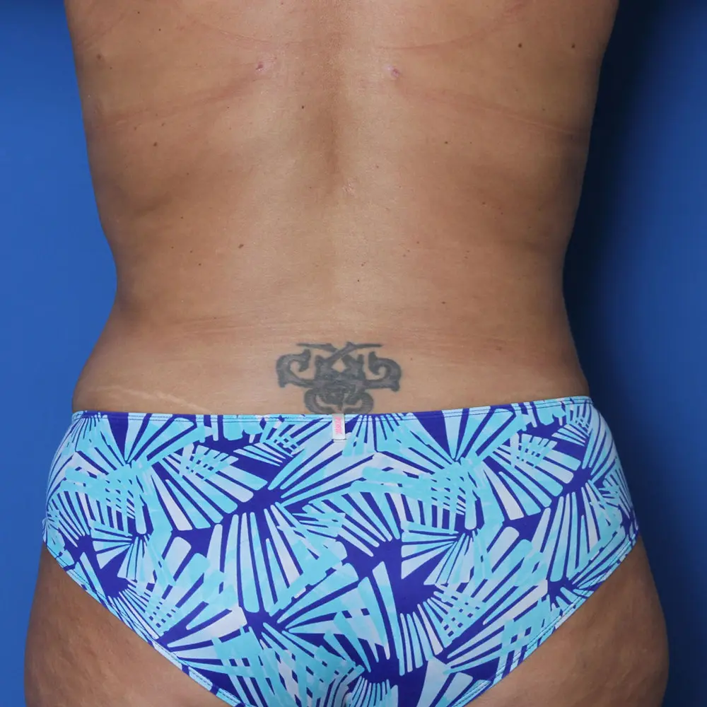 Liposuction Patient Photo - Case 155 - after view
